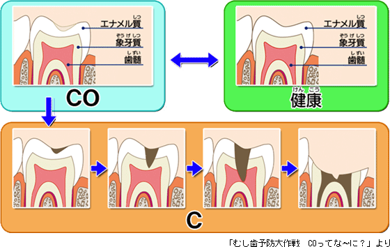 虫歯の進行状況