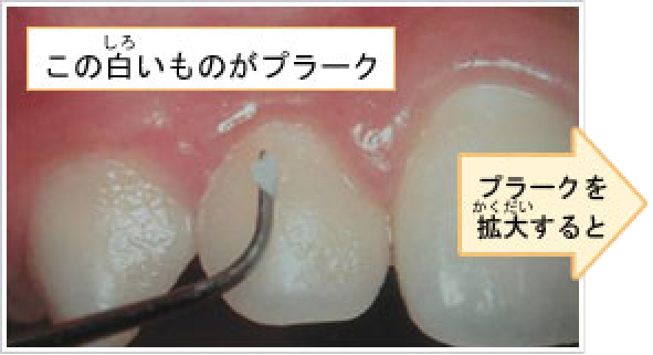 この白いものがプラーク