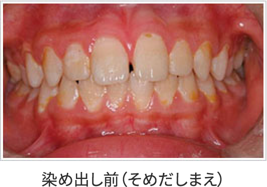 染め出し前